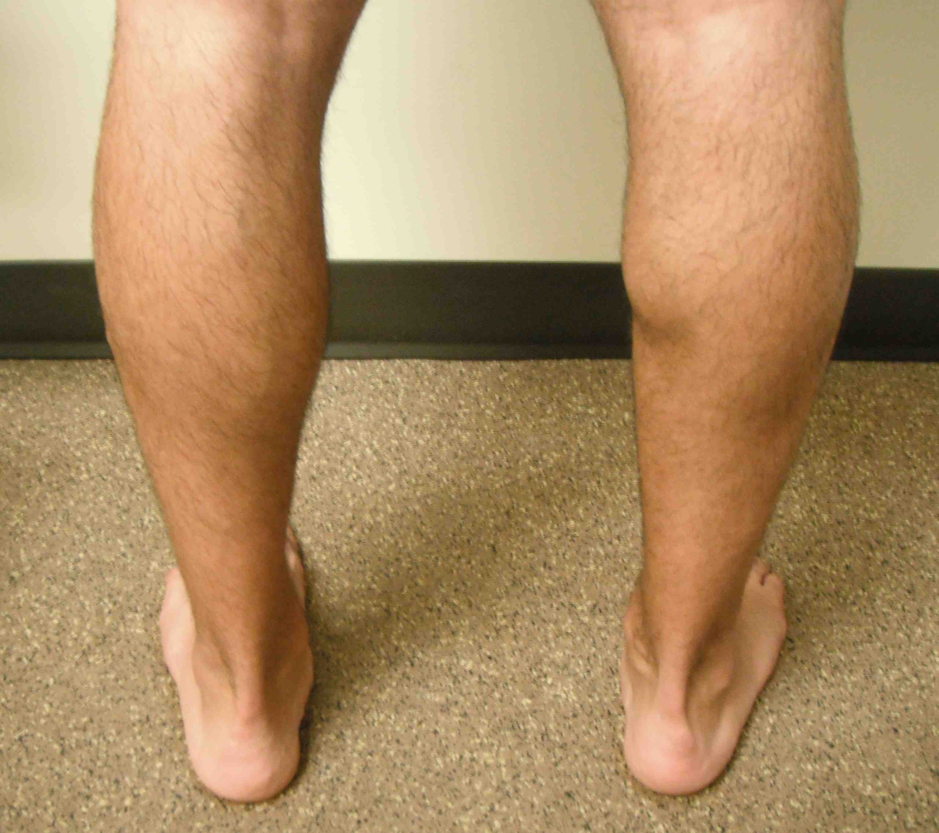 Musculotendinous Gastrocnemius Rupture 2